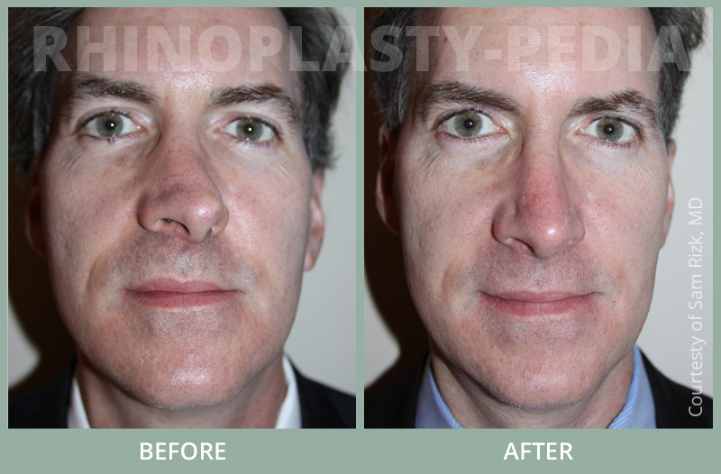 rhinoplasty male patient before and after photo 4