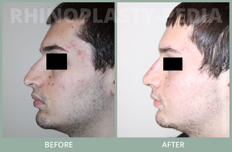 rhinoplasty male patient before and after photo set 20