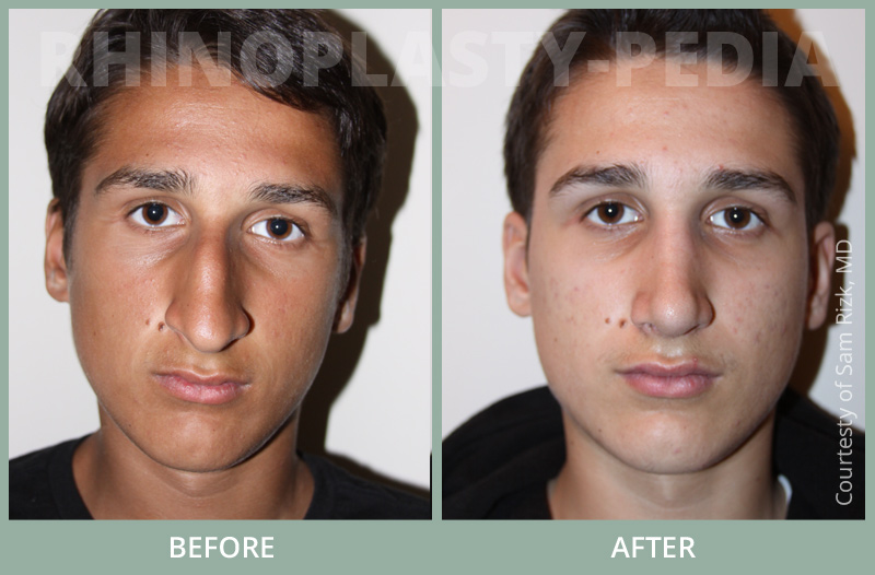 rhinoplasty male patient before and after photo set 23