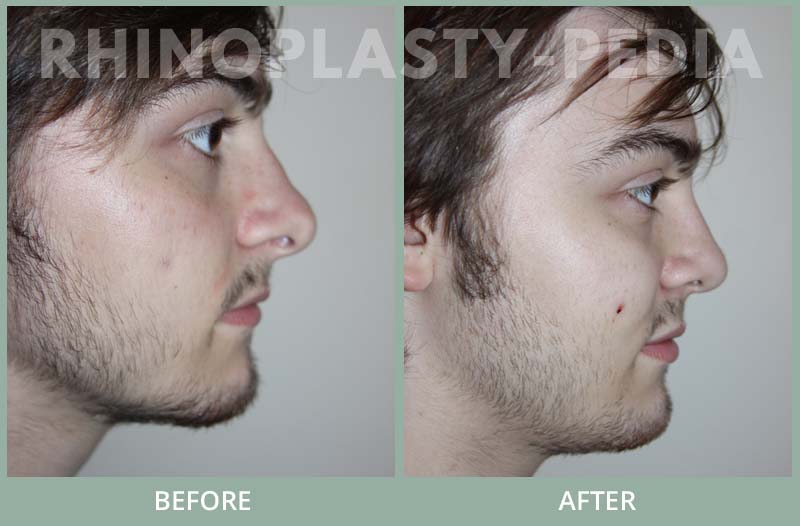 male rhinoplasty patient before and after photo 9