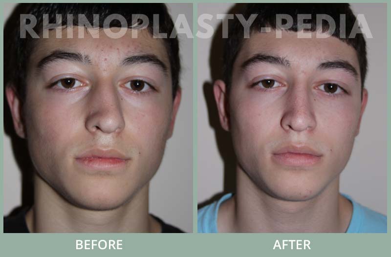 rhinoplasty male patient before and after photo set 34