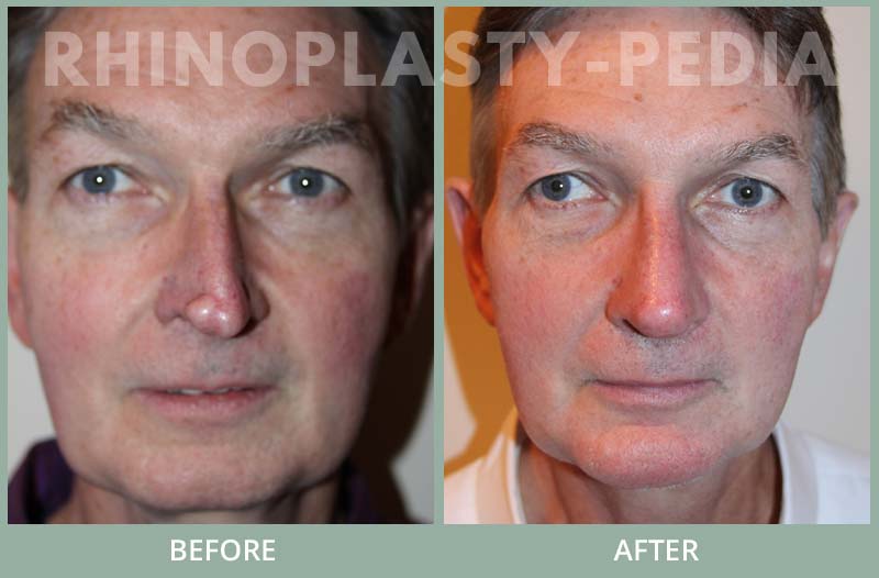 male rhinoplasty patient before and after photo 12