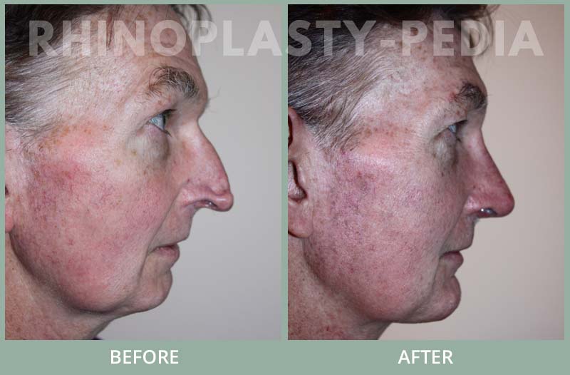 male rhinoplasty patient before and after photo 12