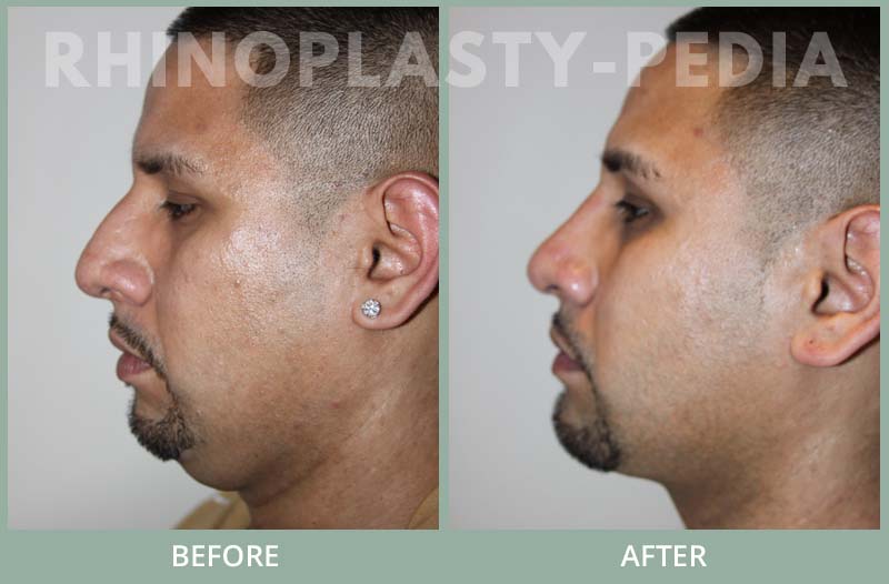 rhinoplasty male patient before and after photo 8