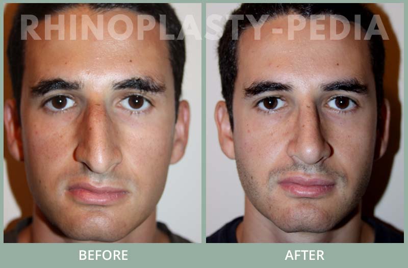 rhinoplasty male patient before and after photo 10