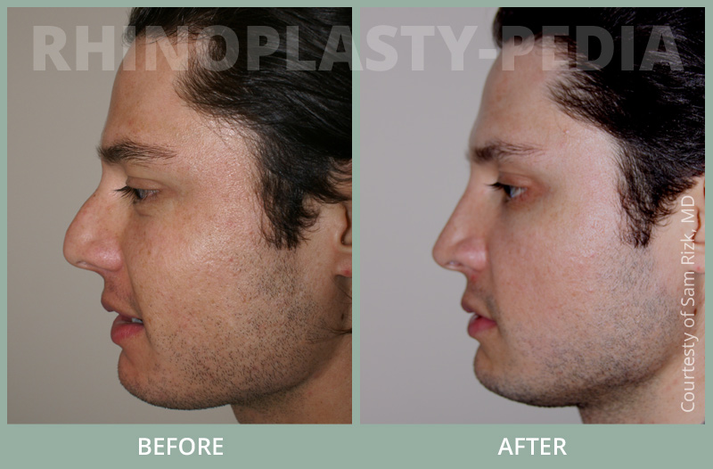 rhinoplasty male patient before and after photo set 26