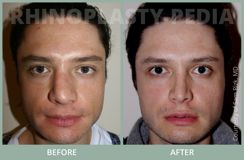 male rhinoplasty patient before and after photo 7