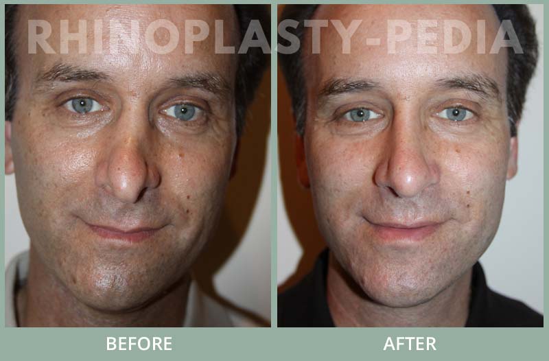 rhinoplasty male patient before and after photo set 47