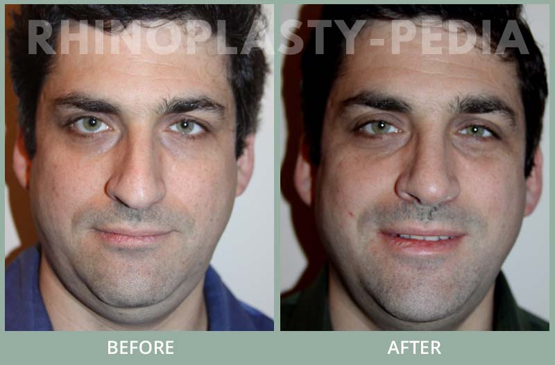 rhinoplasty male patient before and after photo set 48