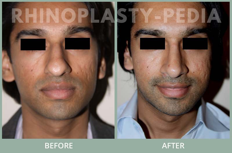 rhinoplasty male patient before and after photo set 50