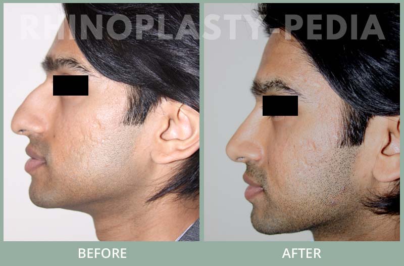 rhinoplasty male patient before and after photo set 51