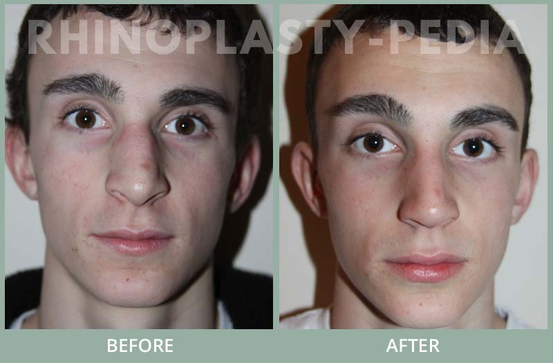 male rhinoplasty patient before and after photo 21