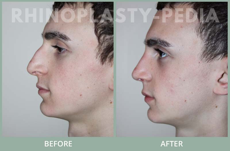 rhinoplasty male patient before and afterm set 52