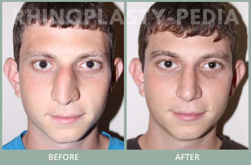 rhinoplasty male patient before and after photo 19