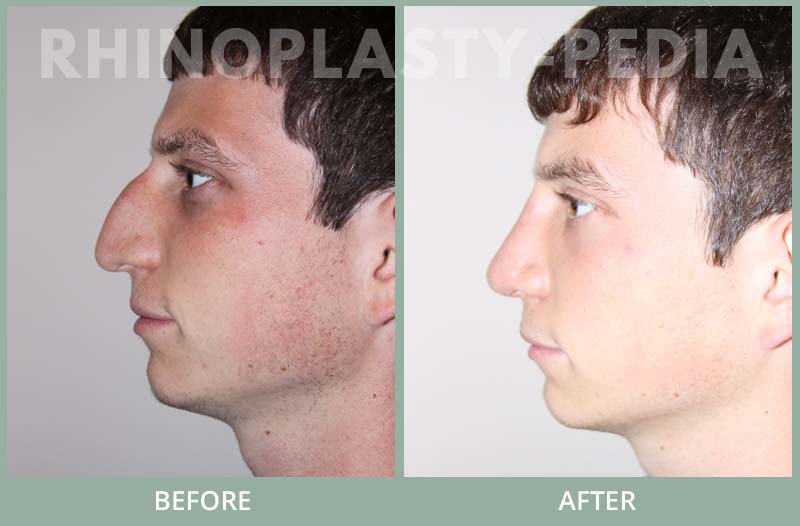 rhinoplasty male patient before and after photo set 55