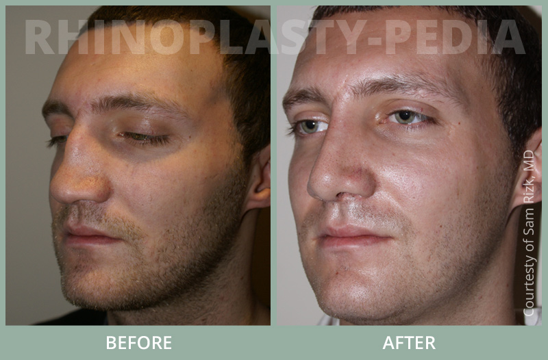 rhinoplasty surgery male patient before and after photo 1