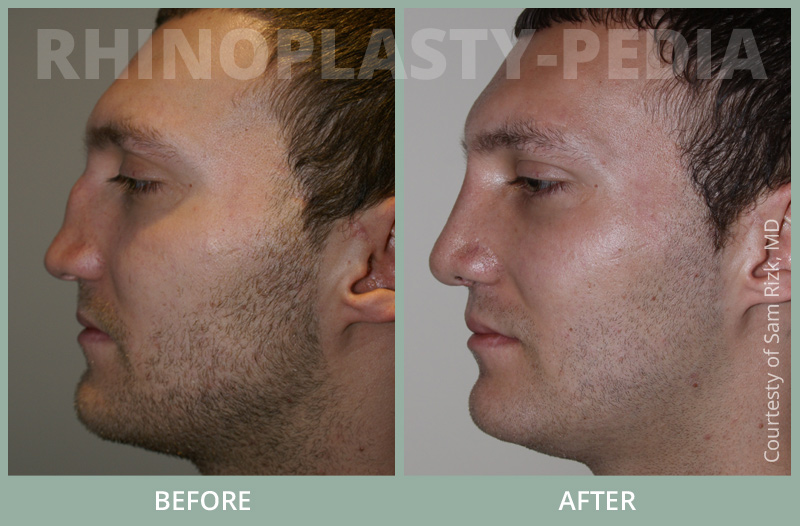 male rhinoplasty patient before and after photo 2