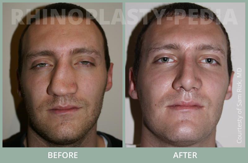 rhinoplasty for a crooked nose male patient before and after rhinoplasty photo