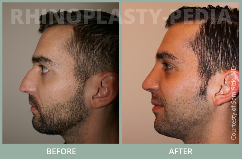 rhinoplasty male patient before and after photo set 29