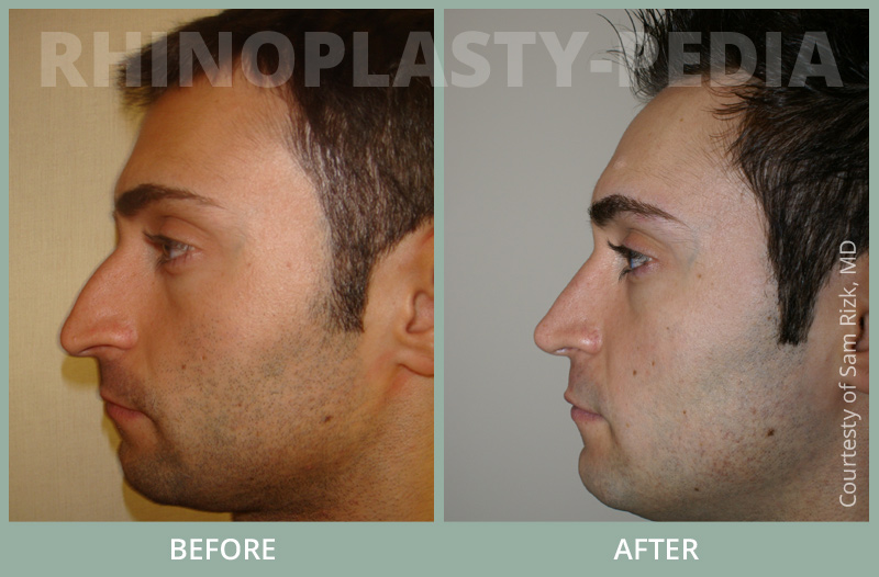 rhinoplasty male patient before and after photo set 15