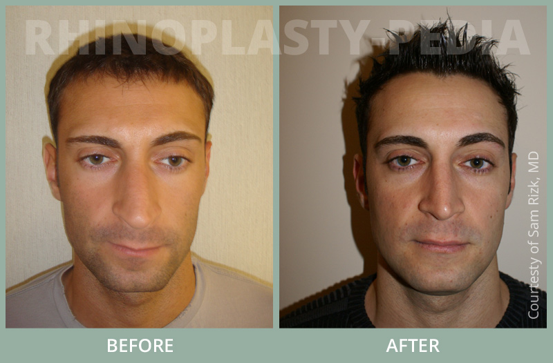 rhinoplasty male patient before and after photo 1
