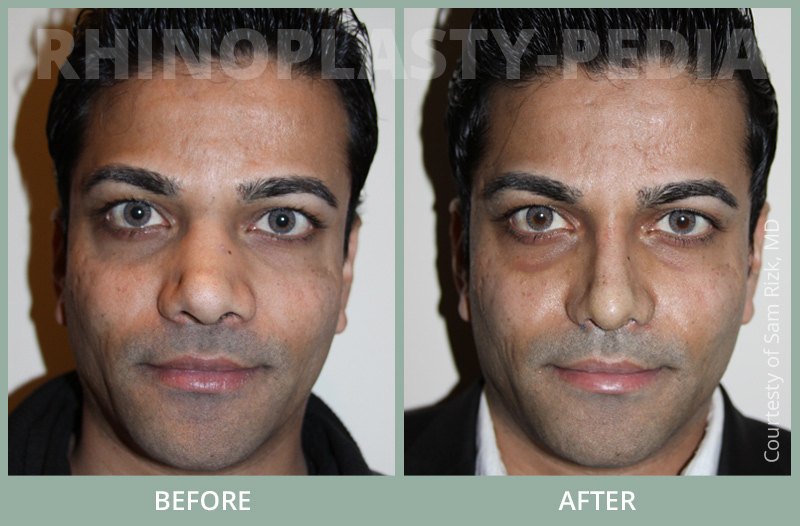 rhinoplasty male patient before and after photo set 8