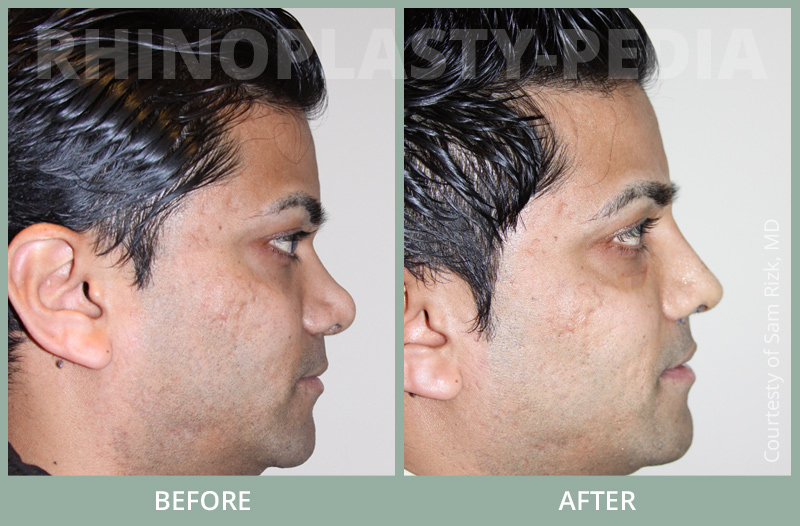 rhinoplasty male paient before and after photo set 9