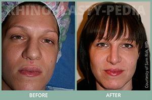 rhinoplasty female patient before and after thumb photo 31