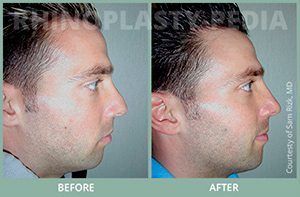 rhinoplasty male patient before and after photo thumb 3