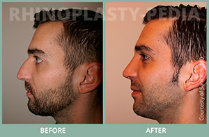 rhinoplasty for drooping nose male patient before and after rhinoplasty photo thumb
