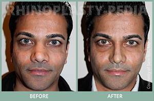 rhinoplasty male patient before and after photo 17