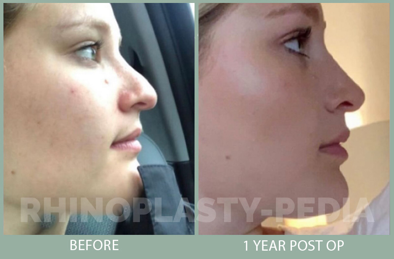 rhinoplasty female patient before and after photo set 78