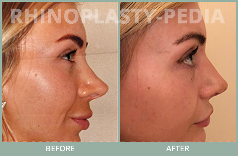 rhinoplasty female patient before and after photo set 79
