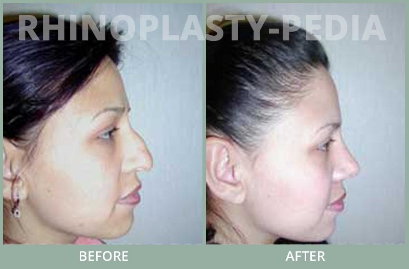 rhinoplasty female patient before and after photo set 69