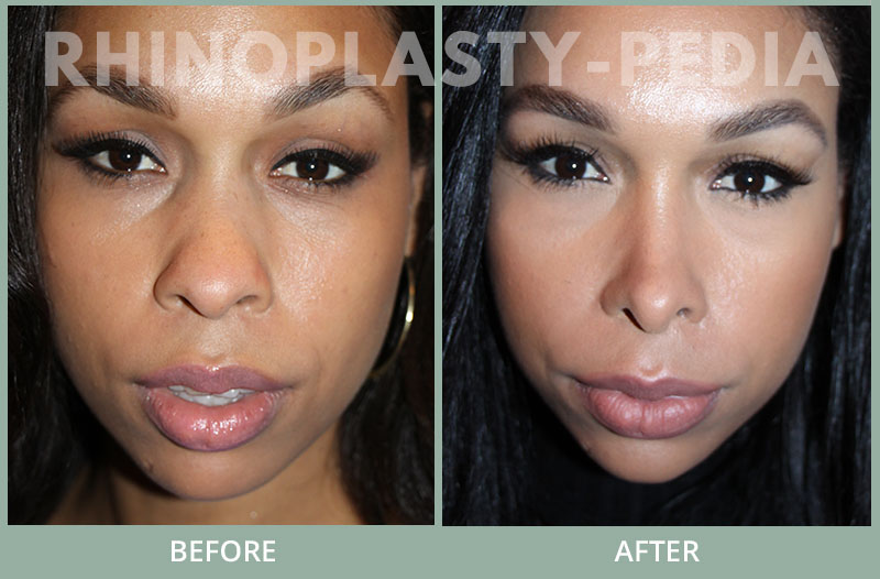 female rhinoplasty patient before and after photo 46