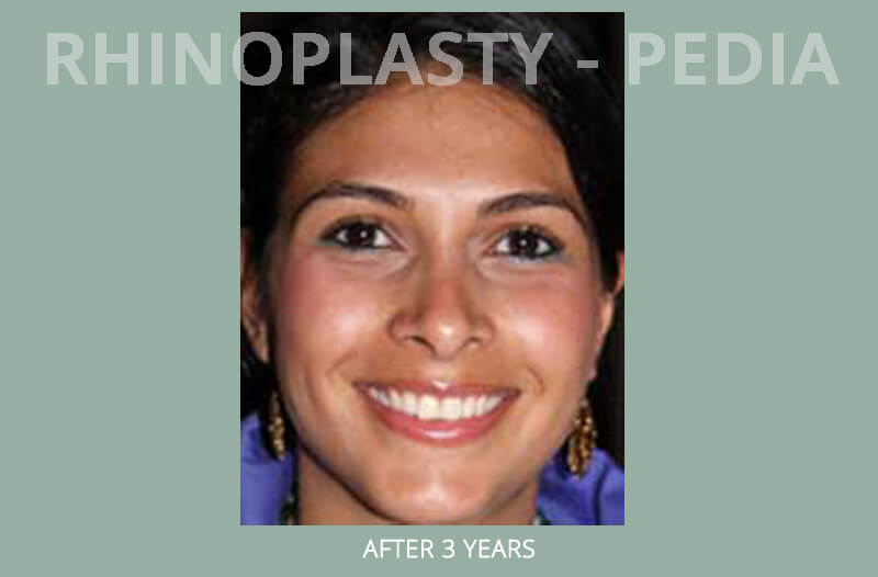 rhinoplasty female patient before and after photo set 20
