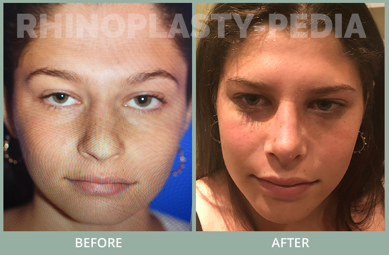 rhinoplasty female patient before and after photo set 58