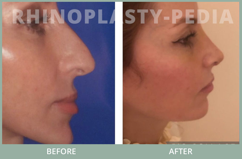 female rhinoplasty patient before and after photo 2