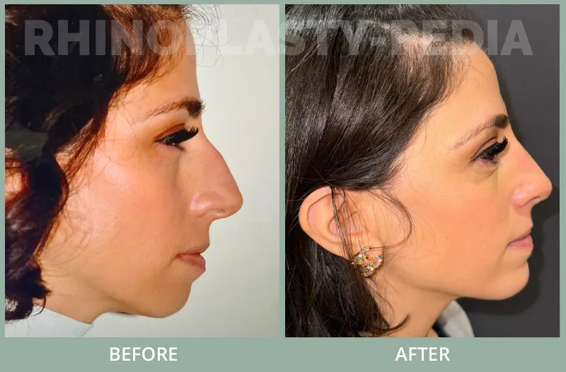 Patient is 4 months after rhinoplasty / chin implant. Note jawline / nose balance by removing bump and augmenting chin creating a better jawline.