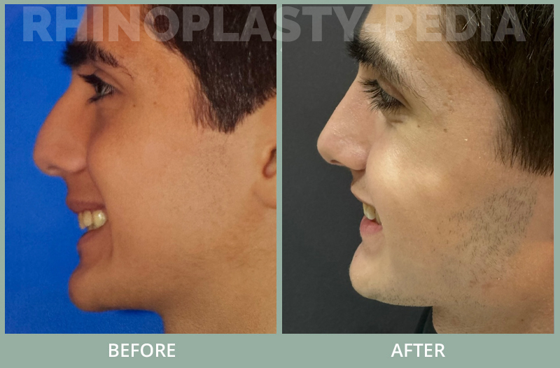 Teenage patient underwent conservative septoplasty/ rhinoplasty to remove bump and repair breathing