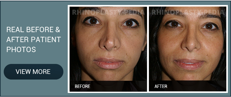 open rhinoplasty patient before and after photo