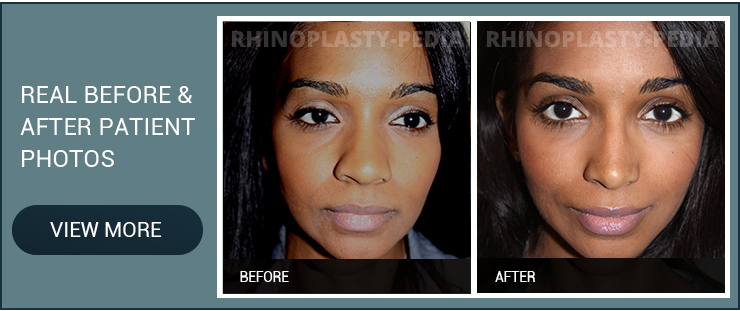 closed rhinoplasty female patient before and after photo