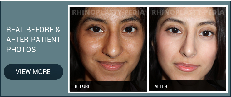 finesse rhinoplasty patient before and after photo banner