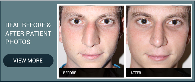 rhinoplasty for a crooked nose real before and after male patient photo