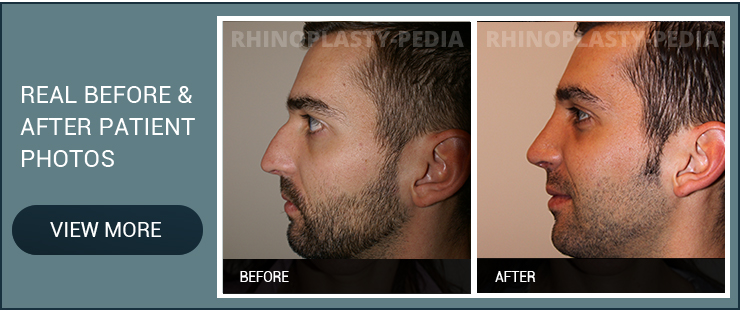 treatment of a deviated septum patient before and after photo