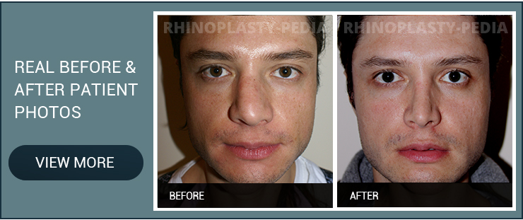 rhinoplasty for nasal reconstruction male patient before and after photo