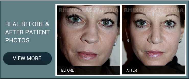 rhinoplasty surgery female patient before and after  photo