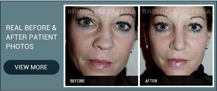 rhinoplasty surgery female patient before and after photo