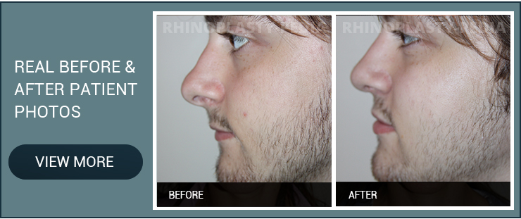 nasal obstruction real before and after male patient photo