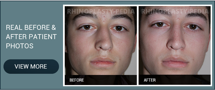 endoscopic sinus surgery before and after patient photo